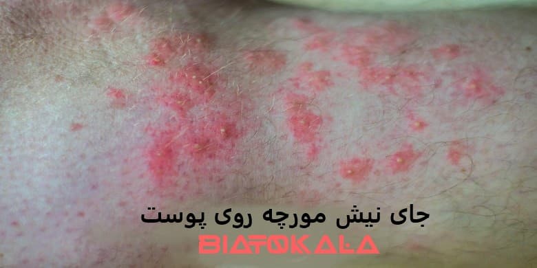 قرمزی و حای نیش مورچه روی پوست نوزاد و انسان